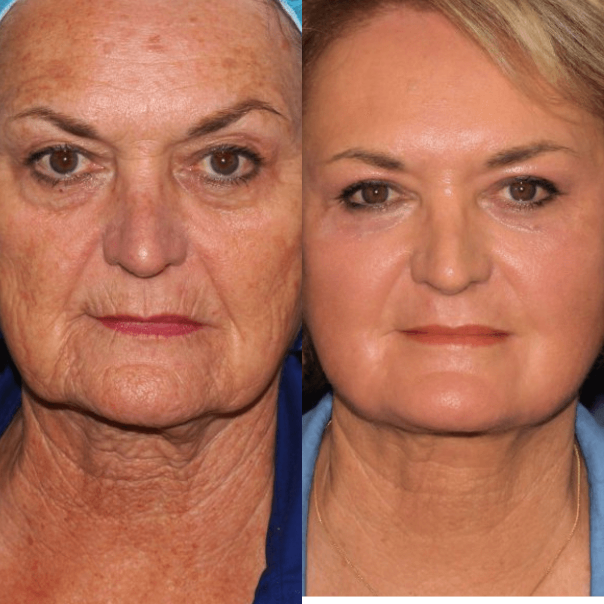 Luxevéria | Erase 98% of Wrinkles & Look 15 Years Younger in Just 7 Days!