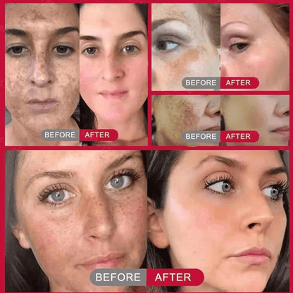 🔥Vitamin C Whitening Freckles Face Cream Remove Melasma Dark Spots Lighten Melanin