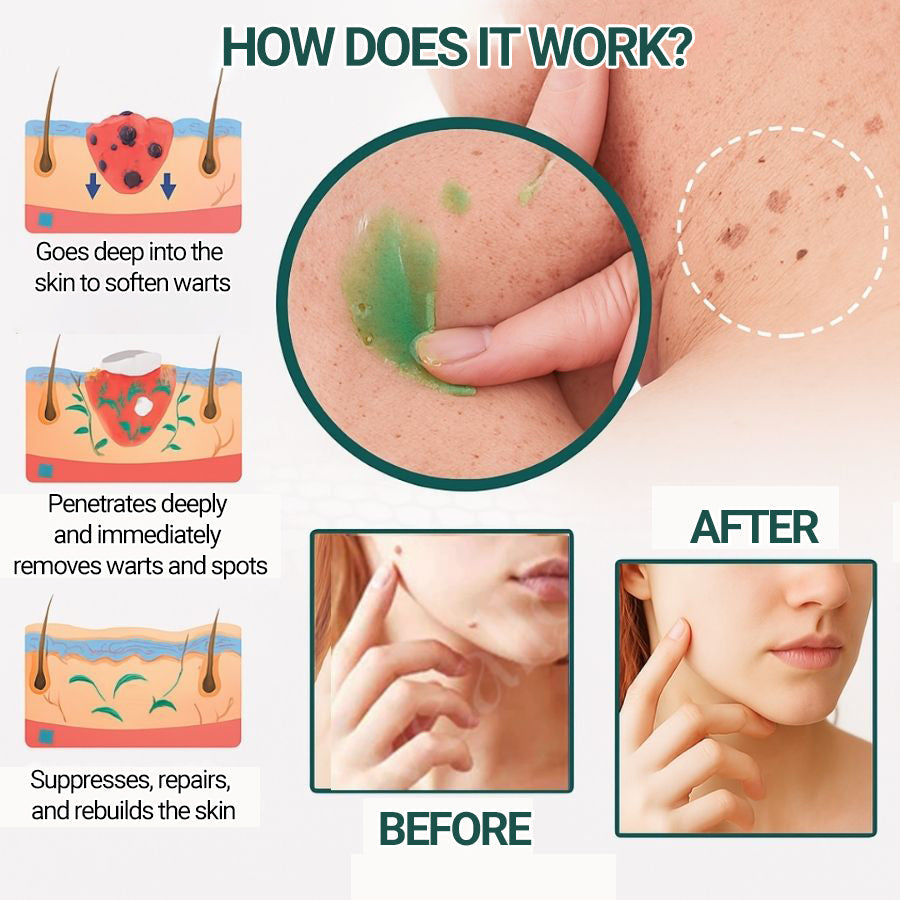 ✨ Luxevéria | Advanced Skin Corrector for Moles, Warts & Imperfections