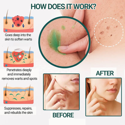 ✨ Luxevéria | Advanced Skin Corrector for Moles, Warts & Imperfections