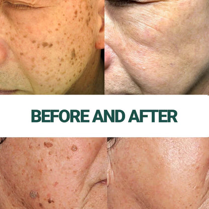 ✨ Luxevéria | Advanced Skin Corrector for Moles, Warts & Imperfections
