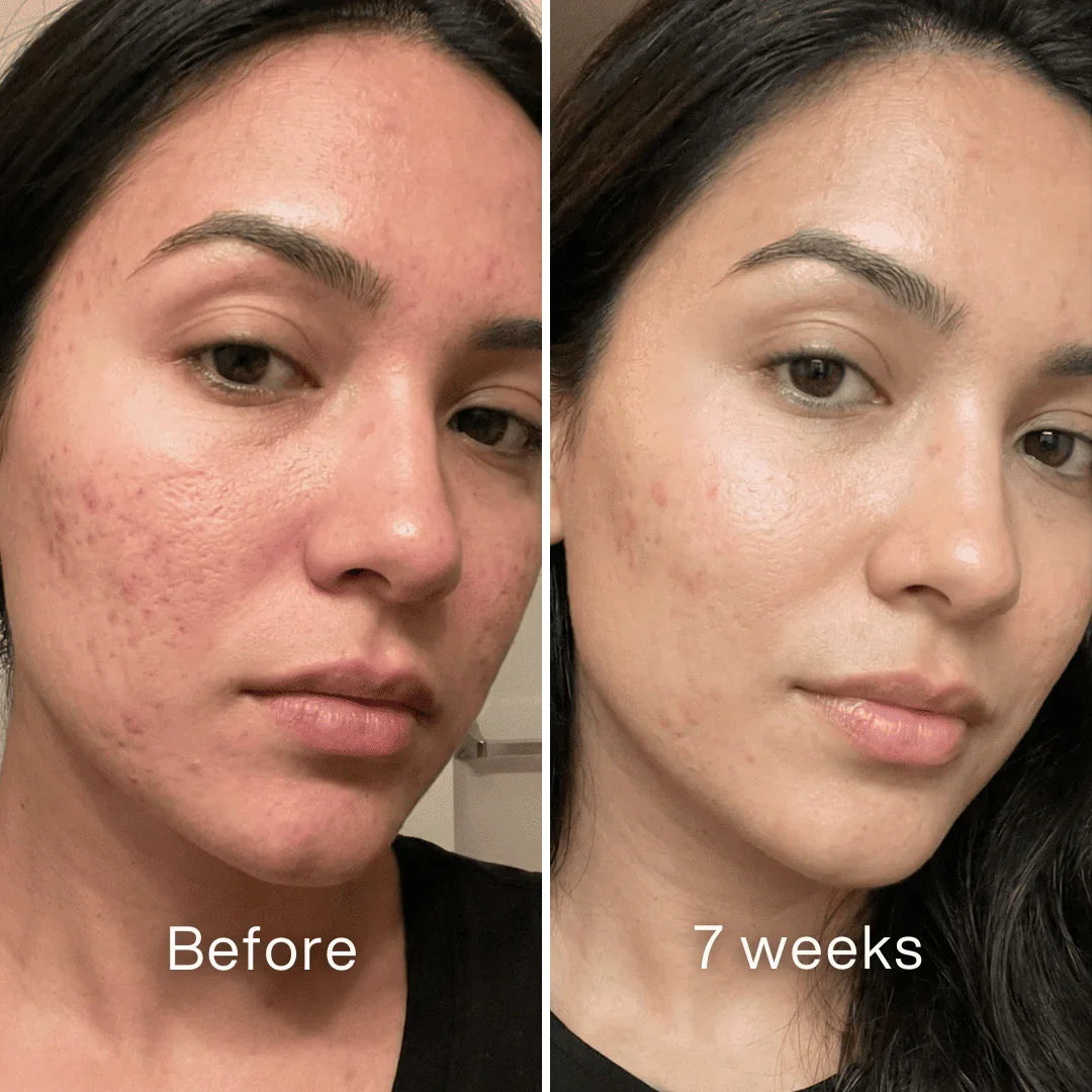 Cheapsu™ Clinical Acne Scar Remodeling Stick